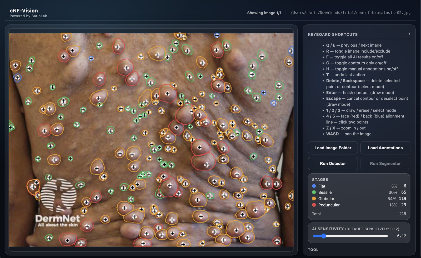 The cNF-Vision tool detecting and classifying cutaneous neurofibromas on a patient's skin, with per-lesion stage counts.