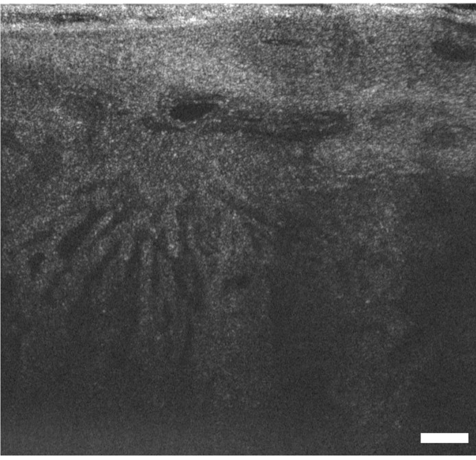 Optical coherence tomography cross-sectional scan of a skin lesion showing its microstructure.